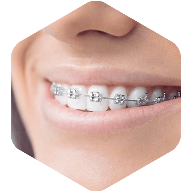 Female with metal braces